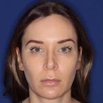 Volux Before & After Patient #13909