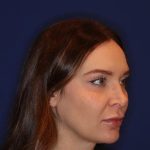 Volux Before & After Patient #13909