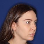 Volux Before & After Patient #13909