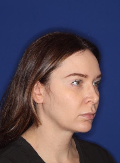 Volux Before & After Patient #13909