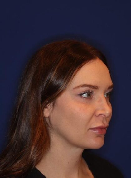 Volux Before & After Patient #13909