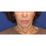 Biostimulatory Filler Before & After Patient #15364