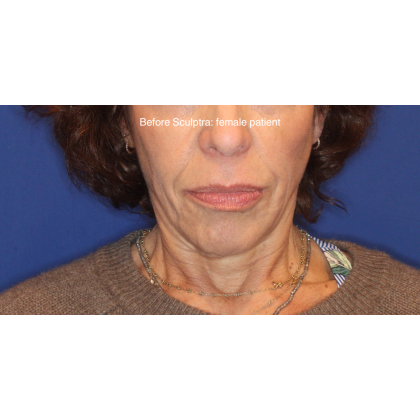 Biostimulatory Filler Before & After Patient #15364