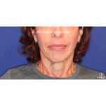 Biostimulatory Filler Before & After Patient #15364