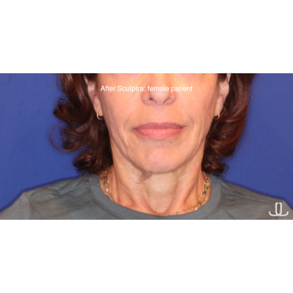 Biostimulatory Filler Before & After Patient #15364