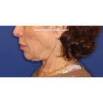 Biostimulatory Filler Before & After Patient #15364