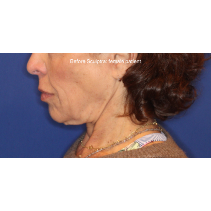 Biostimulatory Filler Before & After Patient #15364
