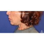 Biostimulatory Filler Before & After Patient #15364
