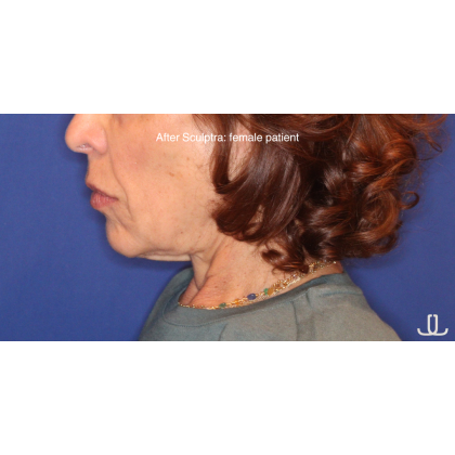 Biostimulatory Filler Before & After Patient #15364