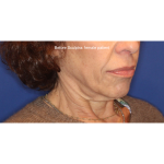 Biostimulatory Filler Before & After Patient #15364