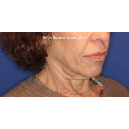 Biostimulatory Filler Before & After Patient #15364