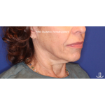 Biostimulatory Filler Before & After Patient #15364