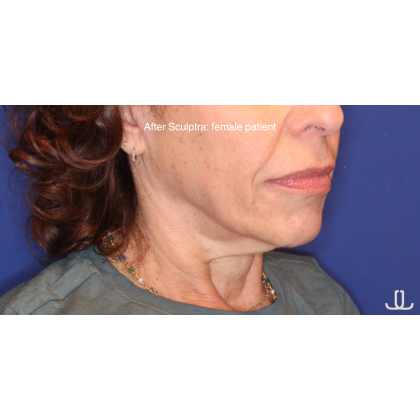 Biostimulatory Filler Before & After Patient #15364