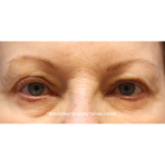 Blepharoplasty Before & After Patient #15665