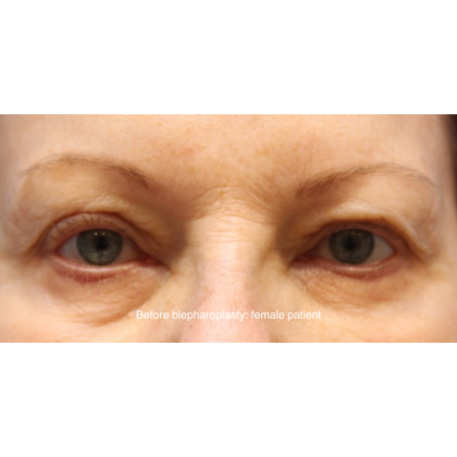 Blepharoplasty Before & After Patient #15665