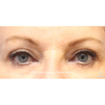 Blepharoplasty Before & After Patient #15665
