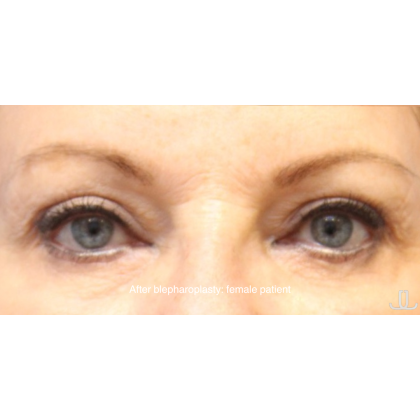 Blepharoplasty Before & After Patient #15665