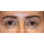 Blepharoplasty Before & After Patient #13437