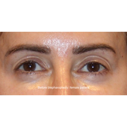 Blepharoplasty Before & After Patient #13437