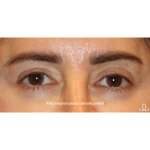 Blepharoplasty Before & After Patient #13437