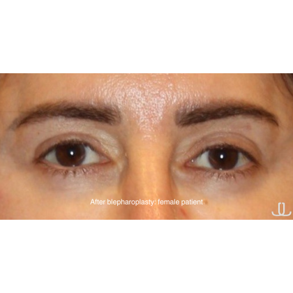 Blepharoplasty Before & After Patient #13437