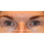 Blepharoplasty Before & After Patient #13435