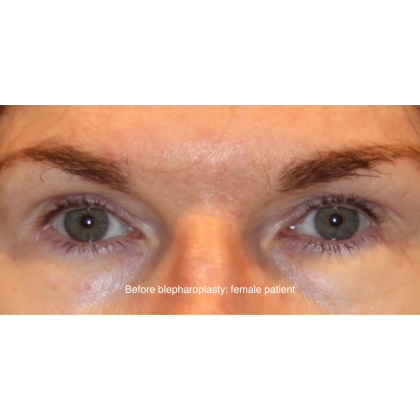 Blepharoplasty Before & After Patient #13435