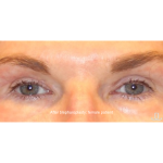 Blepharoplasty Before & After Patient #13435