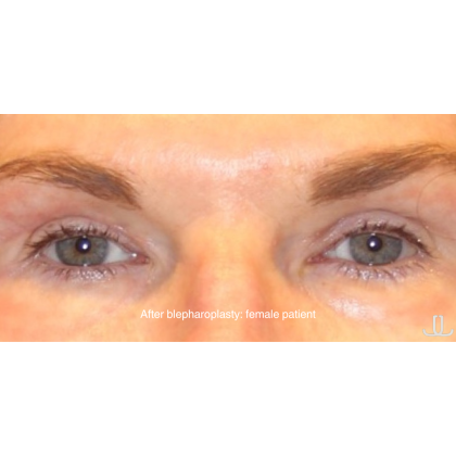 Blepharoplasty Before & After Patient #13435