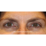Blepharoplasty Before & After Patient #13433