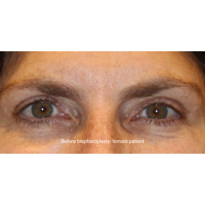 Blepharoplasty Before & After Patient #13433