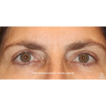 Blepharoplasty Before & After Patient #13433