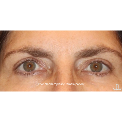 Blepharoplasty Before & After Patient #13433