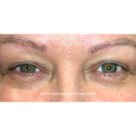 Blepharoplasty Before & After Patient #15012