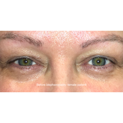 Blepharoplasty Before & After Patient #15012