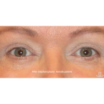 Blepharoplasty Before & After Patient #15012