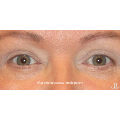 Blepharoplasty Before & After Patient #15012