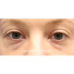 Blepharoplasty Before & After Patient #15011