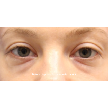 Blepharoplasty Before & After Patient #15011