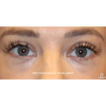 Blepharoplasty Before & After Patient #15011