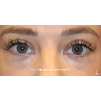Blepharoplasty Before & After Patient #15011