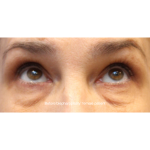 Blepharoplasty Before & After Patient #13444