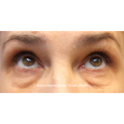 Blepharoplasty Before & After Patient #13444