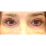Blepharoplasty Before & After Patient #13444