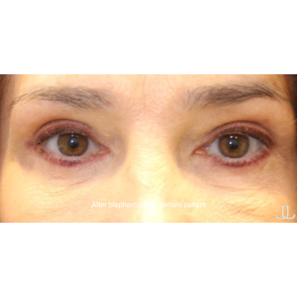 Blepharoplasty Before & After Patient #13444