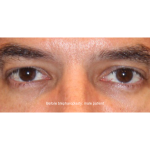 Blepharoplasty Before & After Patient #13482