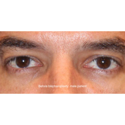 Blepharoplasty Before & After Patient #13482