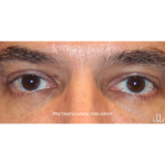 Blepharoplasty Before & After Patient #13482