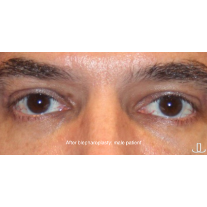 Blepharoplasty Before & After Patient #13482