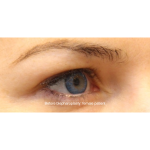 Blepharoplasty Before & After Patient #15009